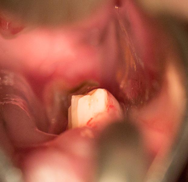 Molar points filed