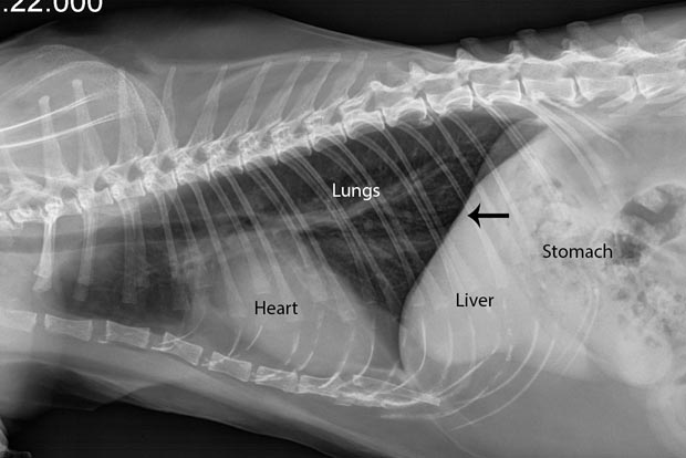 Hernia2