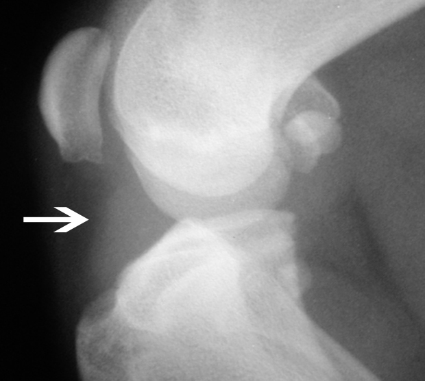 Swelling1