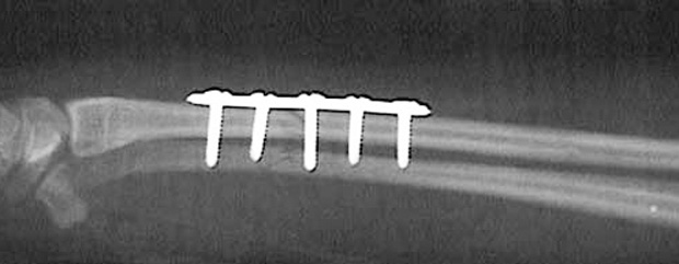 bone plate
