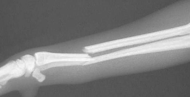 fracture