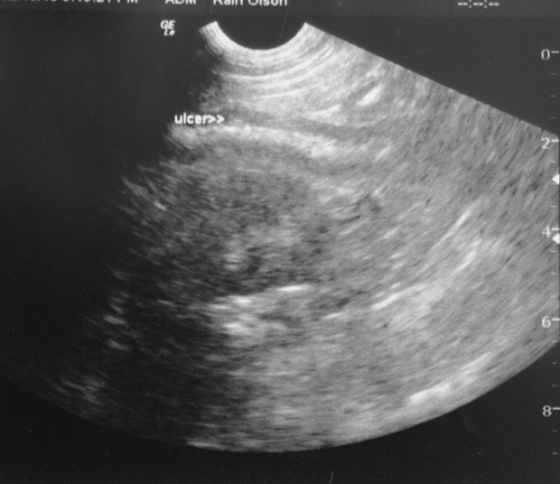 Ulcer