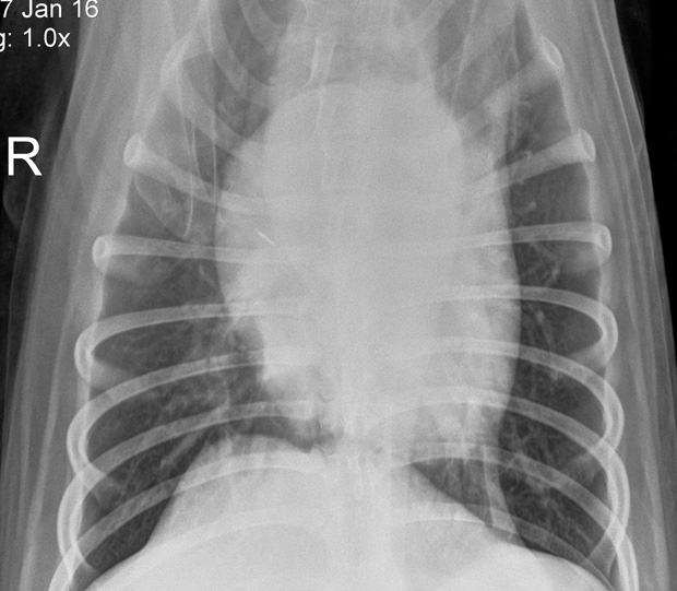 afterpneumoniatreatment